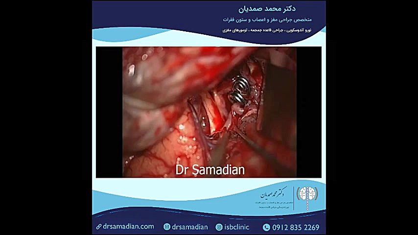 عمل جراحی میکروسکوپی آنوریسم بزرگ کاشت مو