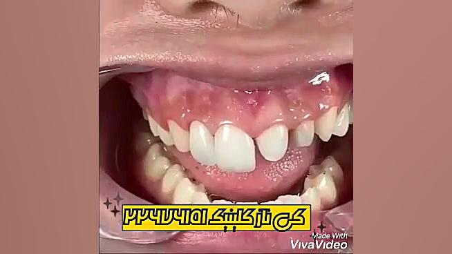 برداشتن لمینت قبل و جایگزین لمینت جدید تست تنفس اوره C13