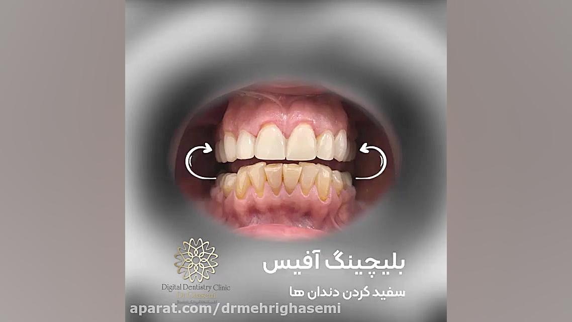 بلیچینگ آفیس (سفید کردن دندان ها) | کلینیک دندانپزشکی دیجیتال دکتر مهری قاسمی مرکز دندانپزشکی دیجیتال دکتر مهری قاسمی