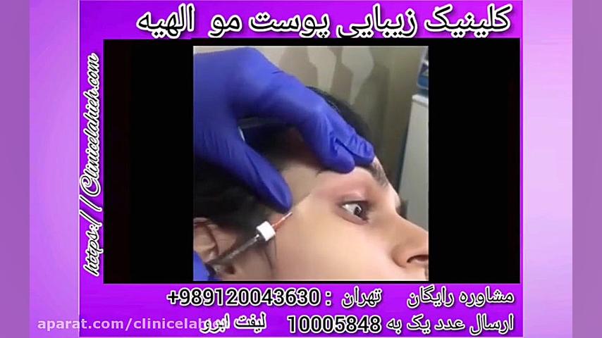 ماندگاری لیفت ابرو چقدر است؟ ترلتینیب