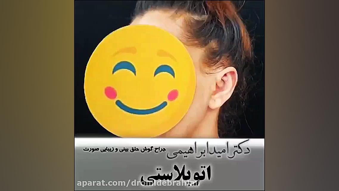 اتوپلاستی توسط دکتر امید ابراهیمی دکتر امید ابراهیمی