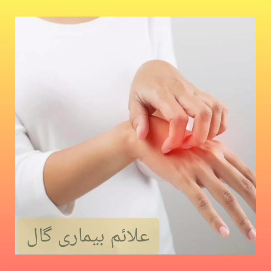 بیماری گال