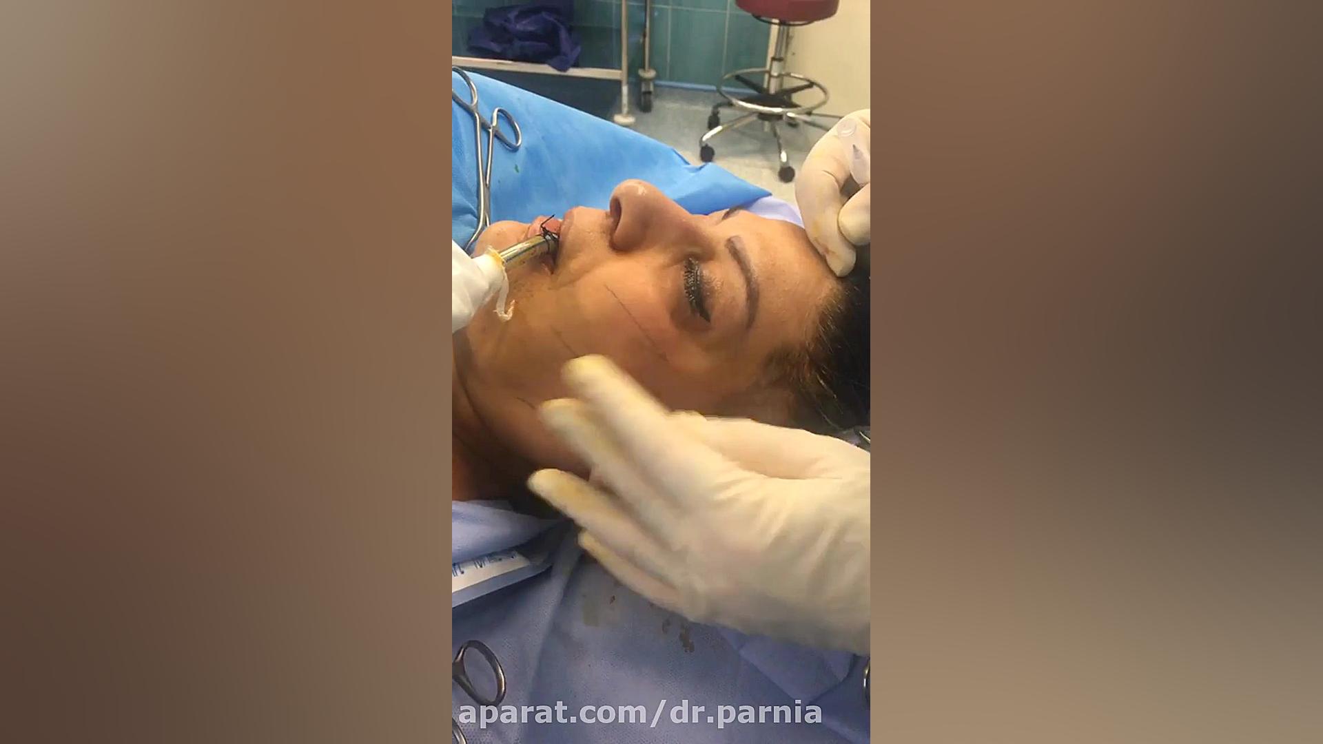 هر آنچه که باید درباره لیفت صورت بدانید دکتر رفیع پرنیا فوق تخصص پلاستیک