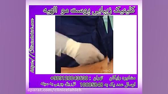 تزریق چربی به سینه بیماری کارنی تین ناقل نقص اولیه