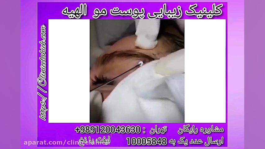لیفت ابرو با نخ بیوسنسور لاکتات خون
