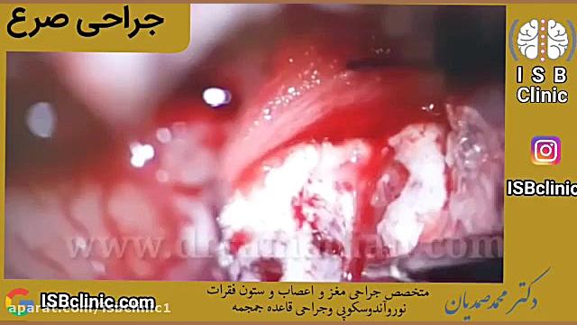 جراحی صرع جراحی زیبایی پلک
