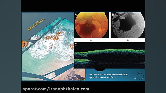 OCT and OCTA in Diabetic Retinopathy فیسبوک