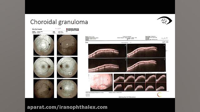 The role of OCT and OCTA in the diagnosis and follow up of patient with uveitis اردک بلوتوثی