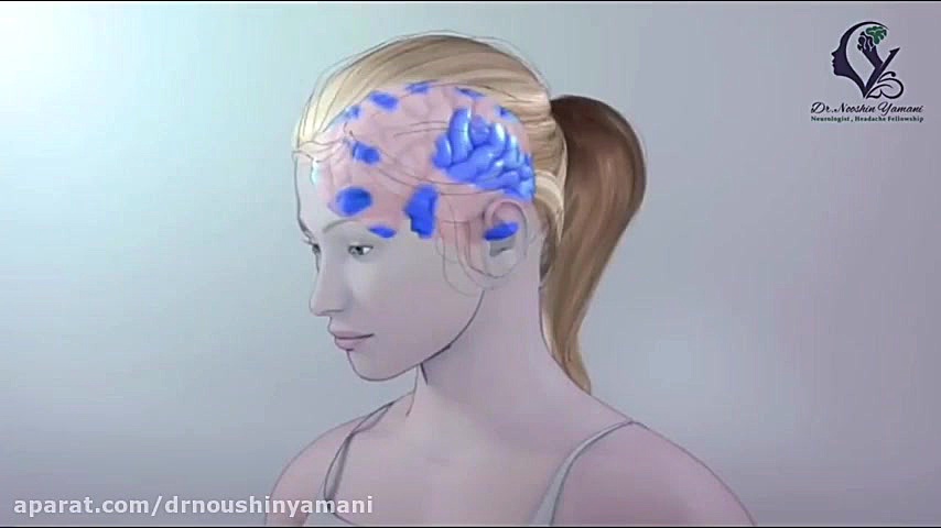 فیلم حمله میگرن دکتر نوشین یمانی متخصص مغز و اعصاب - فلوشیپ سردرد