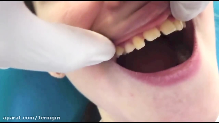 كشیدن دندان شیرى. مهدى سطوتى