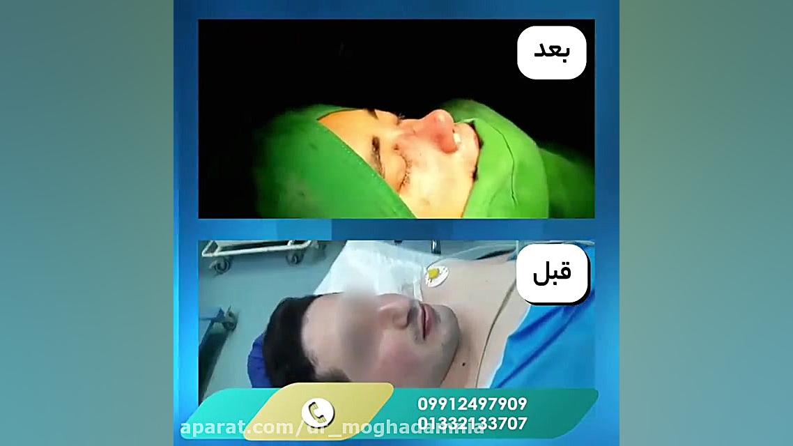 فیلم واقعی عمل زیبایی بینی طبیعی بلافاصله پس از جراحی پوسیدگی دندان