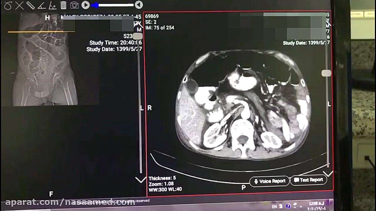 تفسیر ct scan یک کیس انسداد روده کلینیک دندانپزشکی