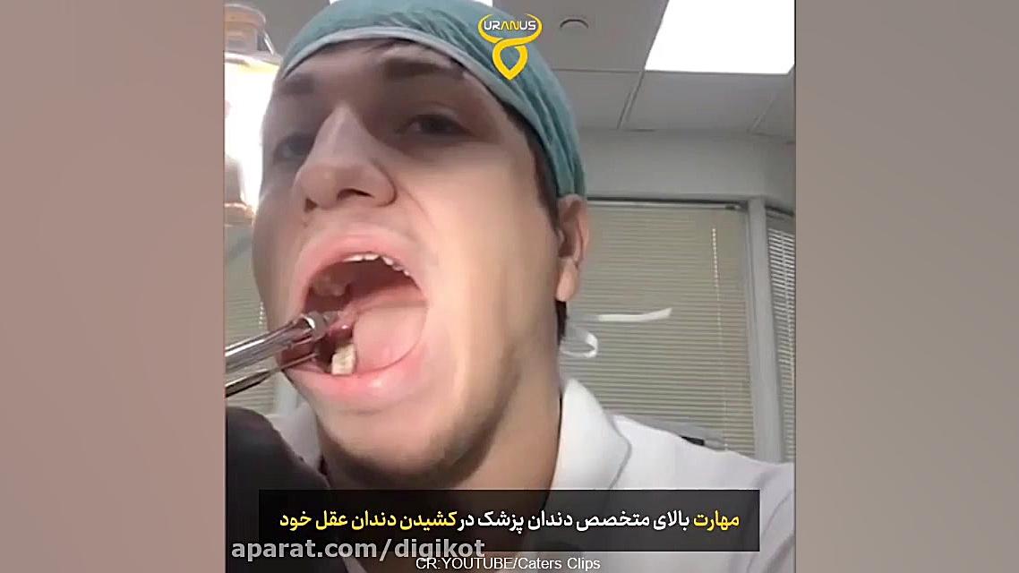 وقتی دندانپزشک خودش برای کشیدن دندان عقلش اقدام می کند دستگاه فیبر نوری جراحی