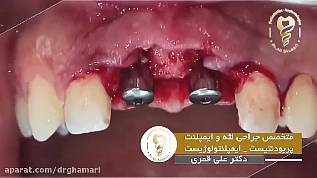 فیلم واقعی ایمپلنت دندان جلو و تغییرات بعد از آن پلاسماجت