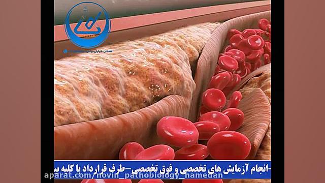 آزمایش چربی بد خون یا LDL آزمایشگاه پاتوبیولوژی نوین همدان