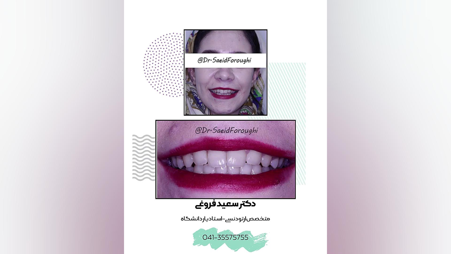 درمان بی نظمی و عدم تطابق دندانهای دو فک توسط ارتودنسی ثابت دکتر سعید فروغی متخصص ارتودنسی