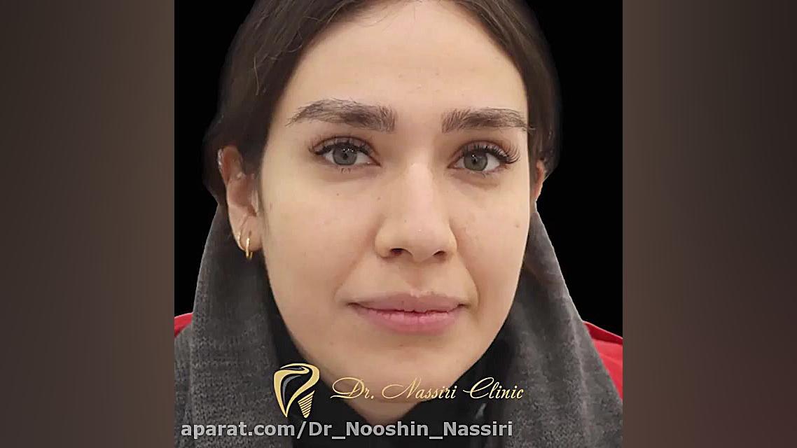 اصلاح طرح لبخند با 14 واحد کامپوزیت ips علامت کرنیگ