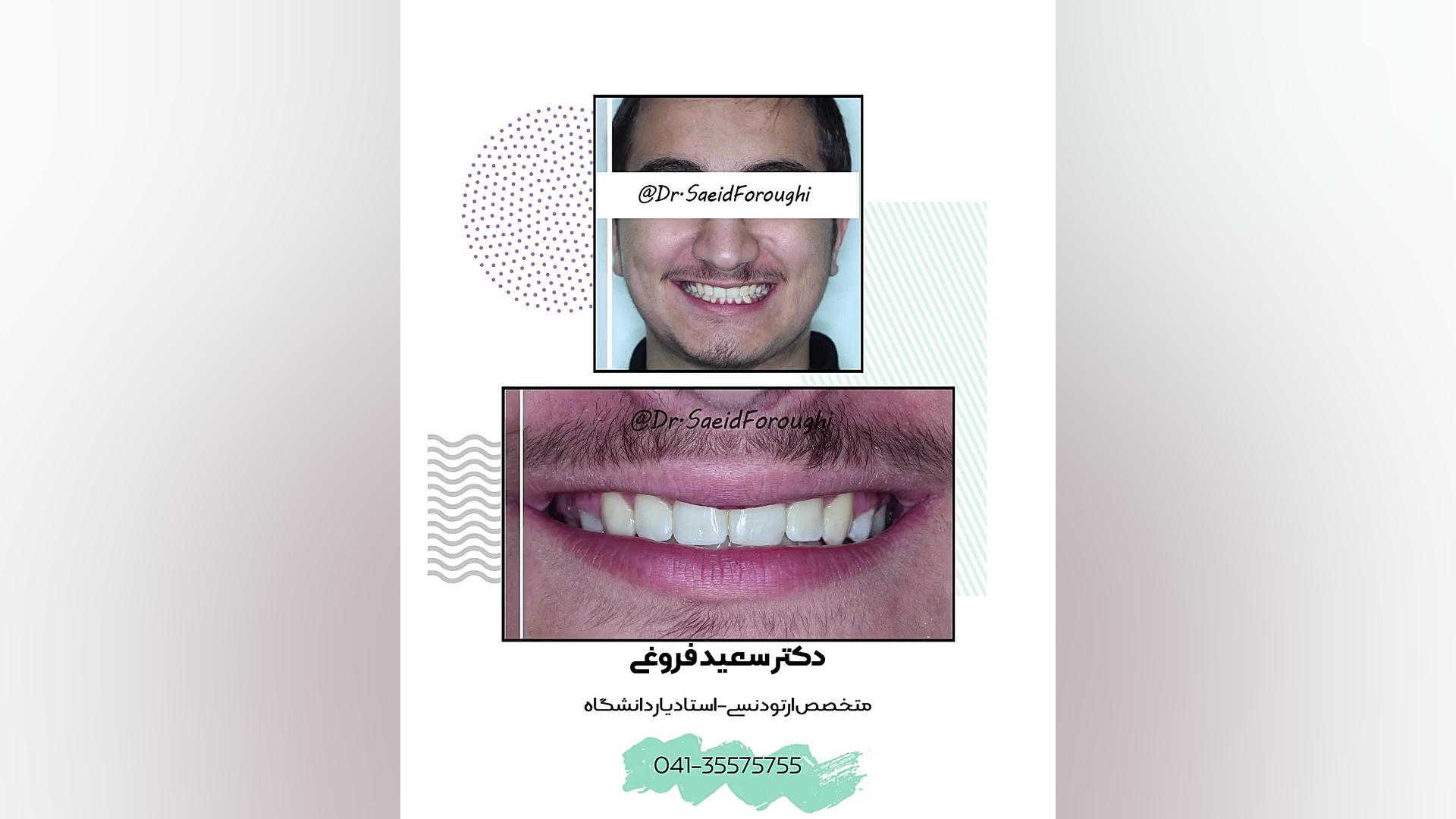 درمان کمبود فضای رویش دندانها و نهفتگی دندان نیش سمت راست فک پایین توسط ارتودنسی هیدروپس فتالیس