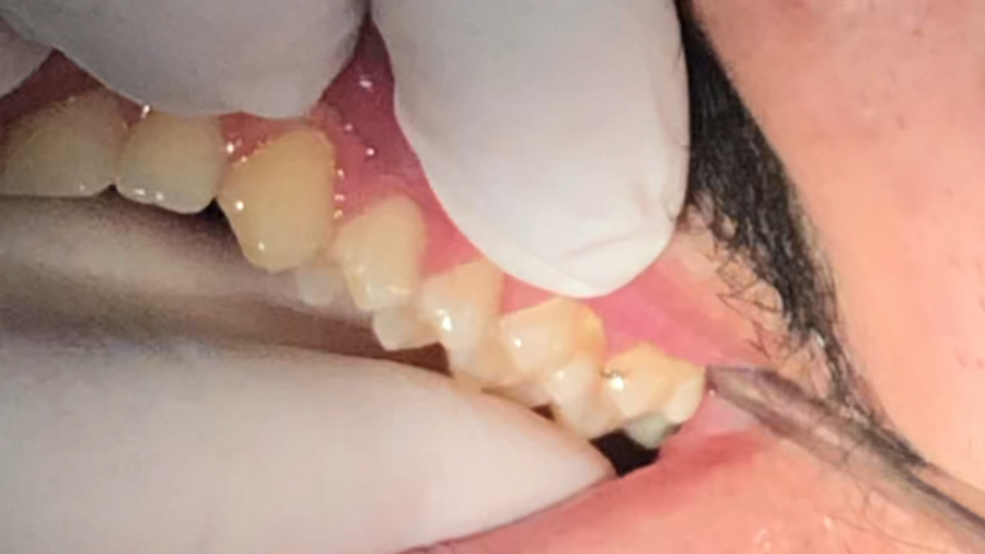 كشيدن دندان عقل فك بالا. مهدى سطوتى