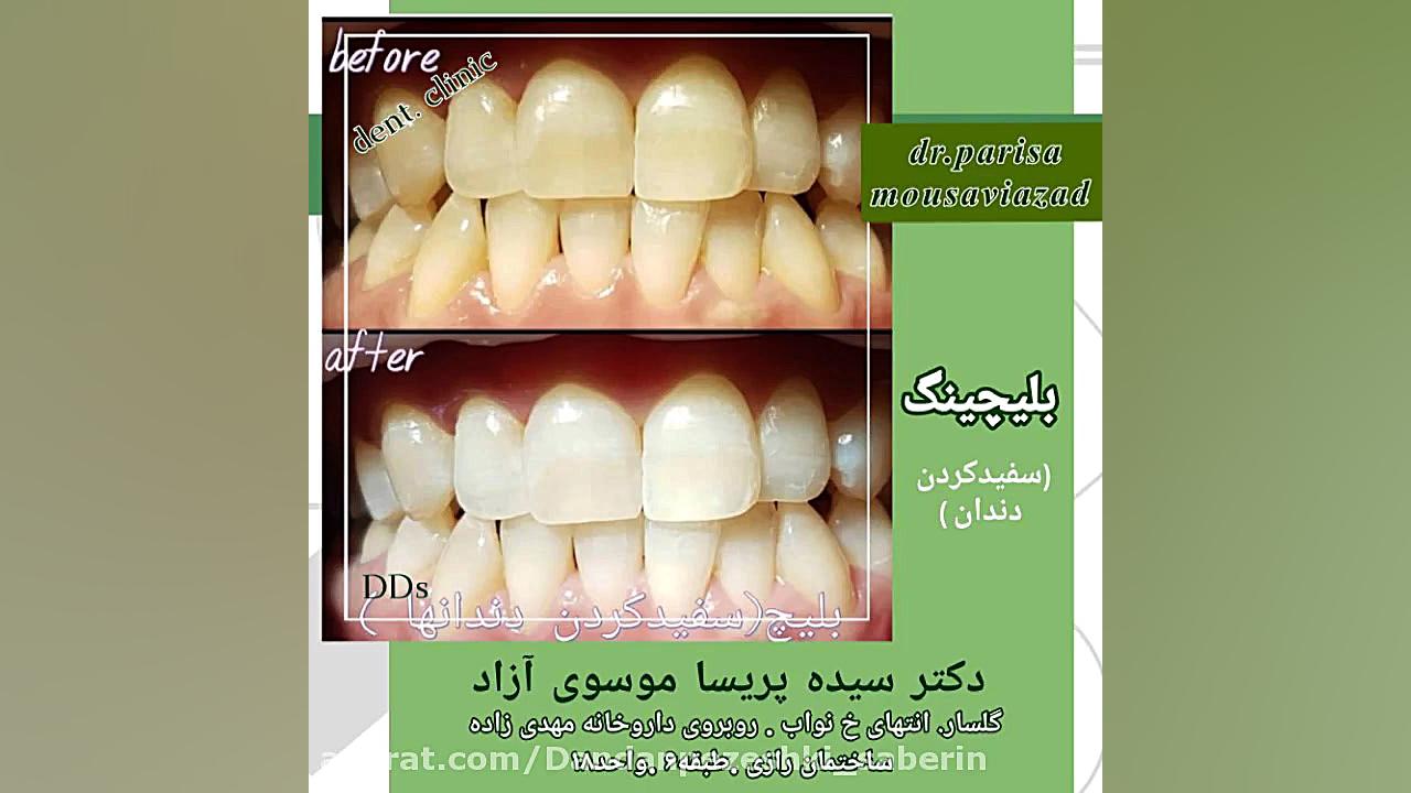 بلیچینگ دندان در رشت. سفید کردن دندان در رشت. Northern Blot