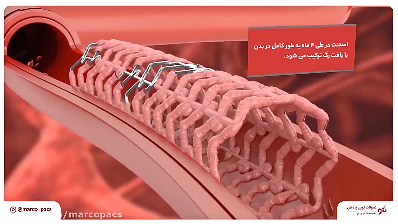 فیلم آنژیوگرافی و نحوه استنت گذاری در قلب لیزر فرکشنال