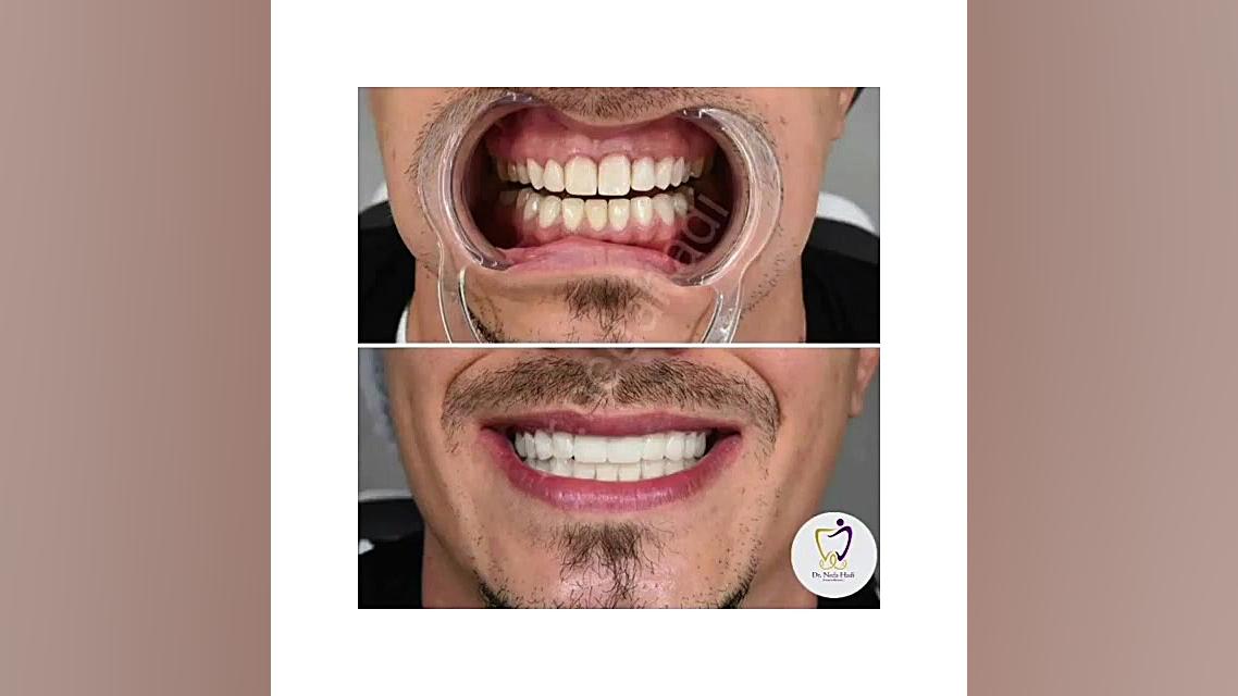 لبخند زیبای یکی دیگر از مراجعه کنندگان عزیزمون دکتر ندا هادی-دندانپزشک زیبایی