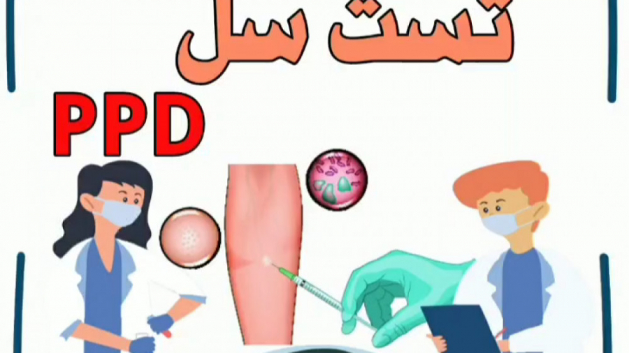 روش انجام آزمایش سل (توبرکولین یا PPD) کلینیک لیزر
