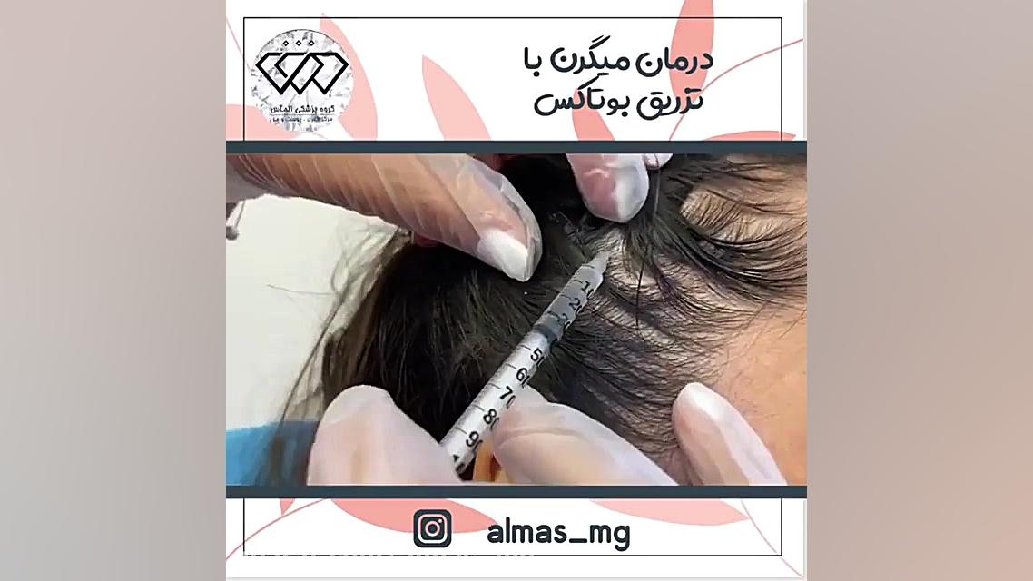 فیلم واقعی درمان میگرن با تزریق بوتاکس ابرسانی پوست