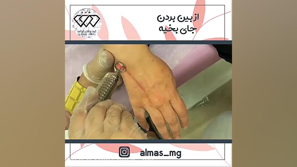 فیلم از بین بردن دائم جای بخیه با لیزر لیفت صورت