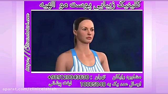 لیفت پیشانی چگونه انجام می شود؟ دستگاه فیبر نوری جراحی