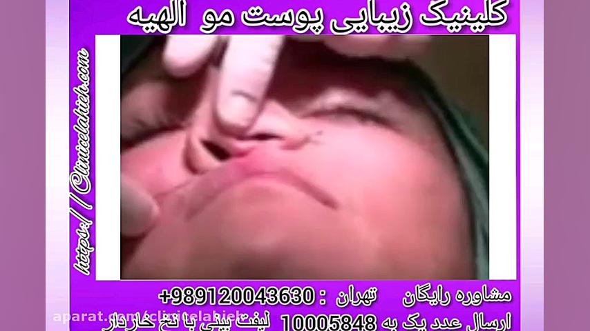لیفت بینی با نخ خاردار جراحی لثه
