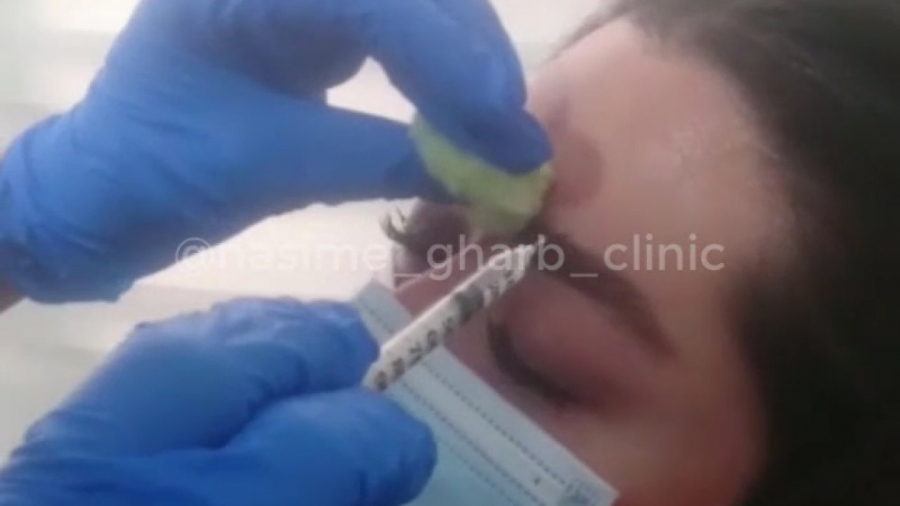 تزریق بوتاکس برای رفع چین و چروک گالکانی زوماب