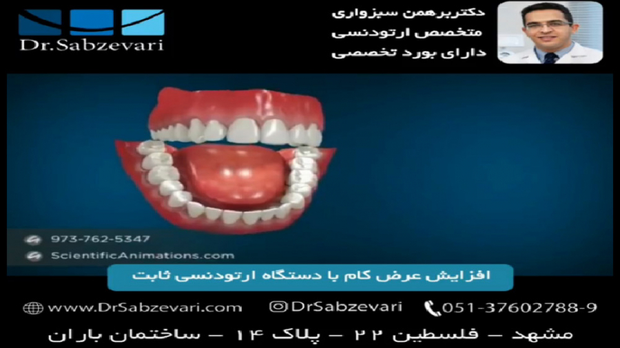 افزایش عرض کام با دستگاه ارتودنسی ثابت دکتر برهمن سبزواری - متخصص ارتودنسی - مشهد