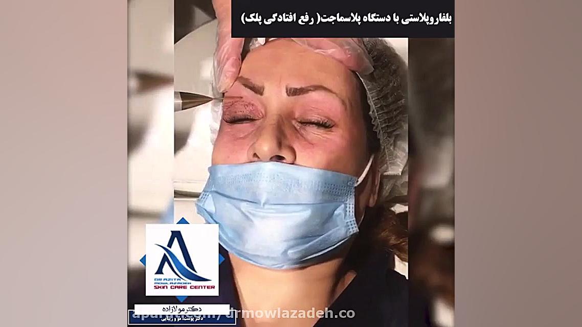 بلفاروپلاستی پلک با دستگاه پلاسما جت بیماری ترومبوسایتوز اسنشیال