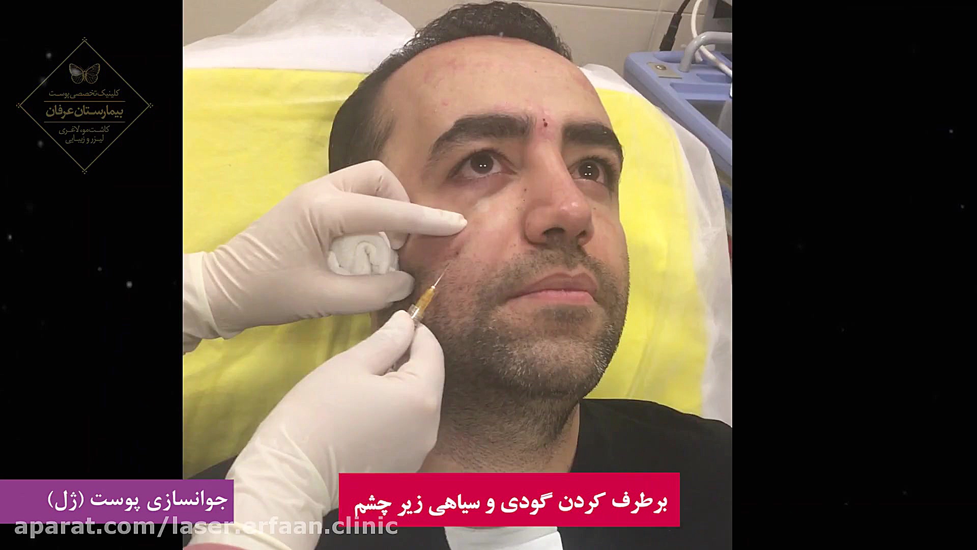 جوانسازی پوست (تزریق ژل) آنیسکوری