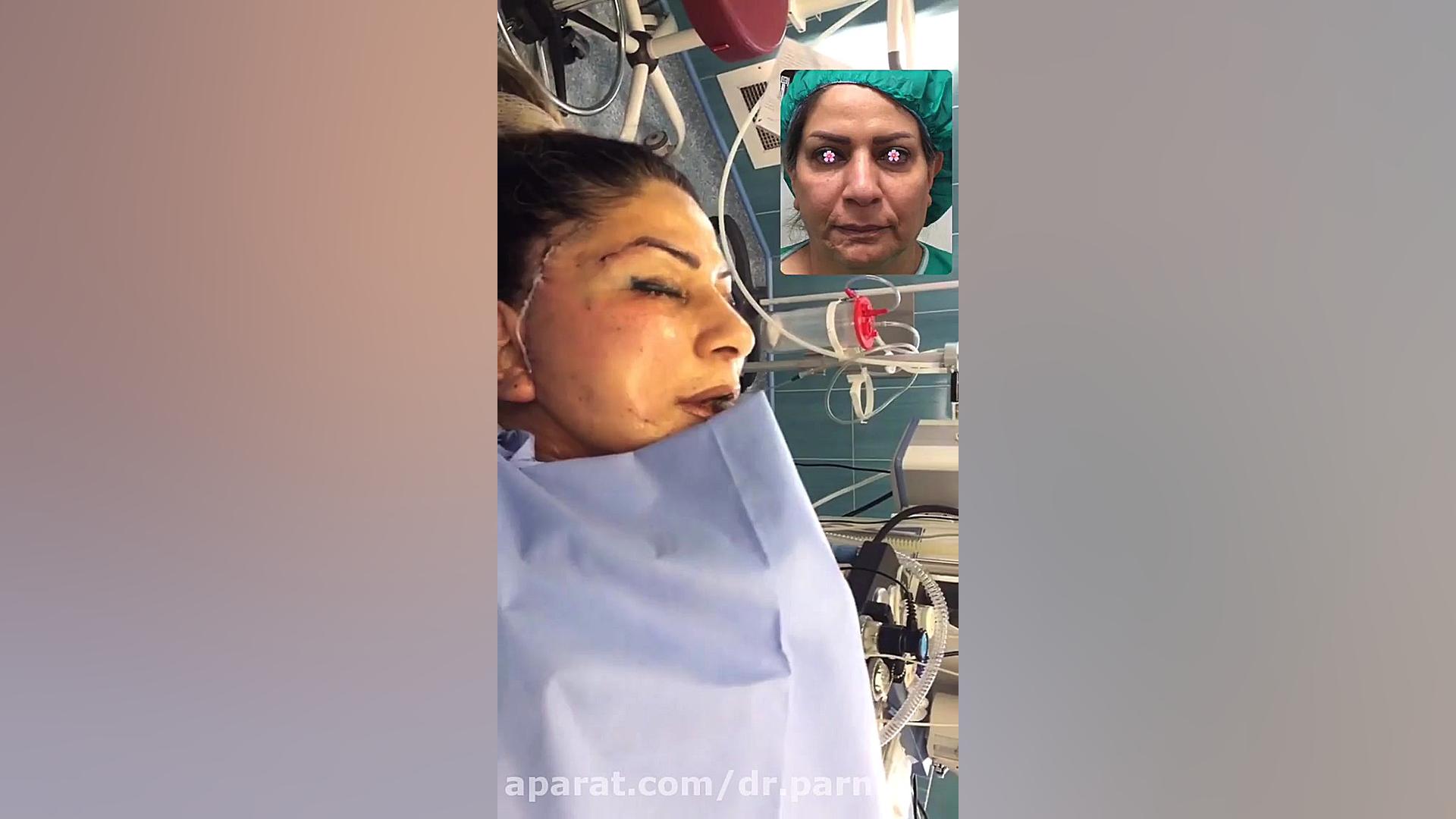 نتیجه جراحی لیفت صورت دکتر رفیع پرنیا فوق تخصص پلاستیک