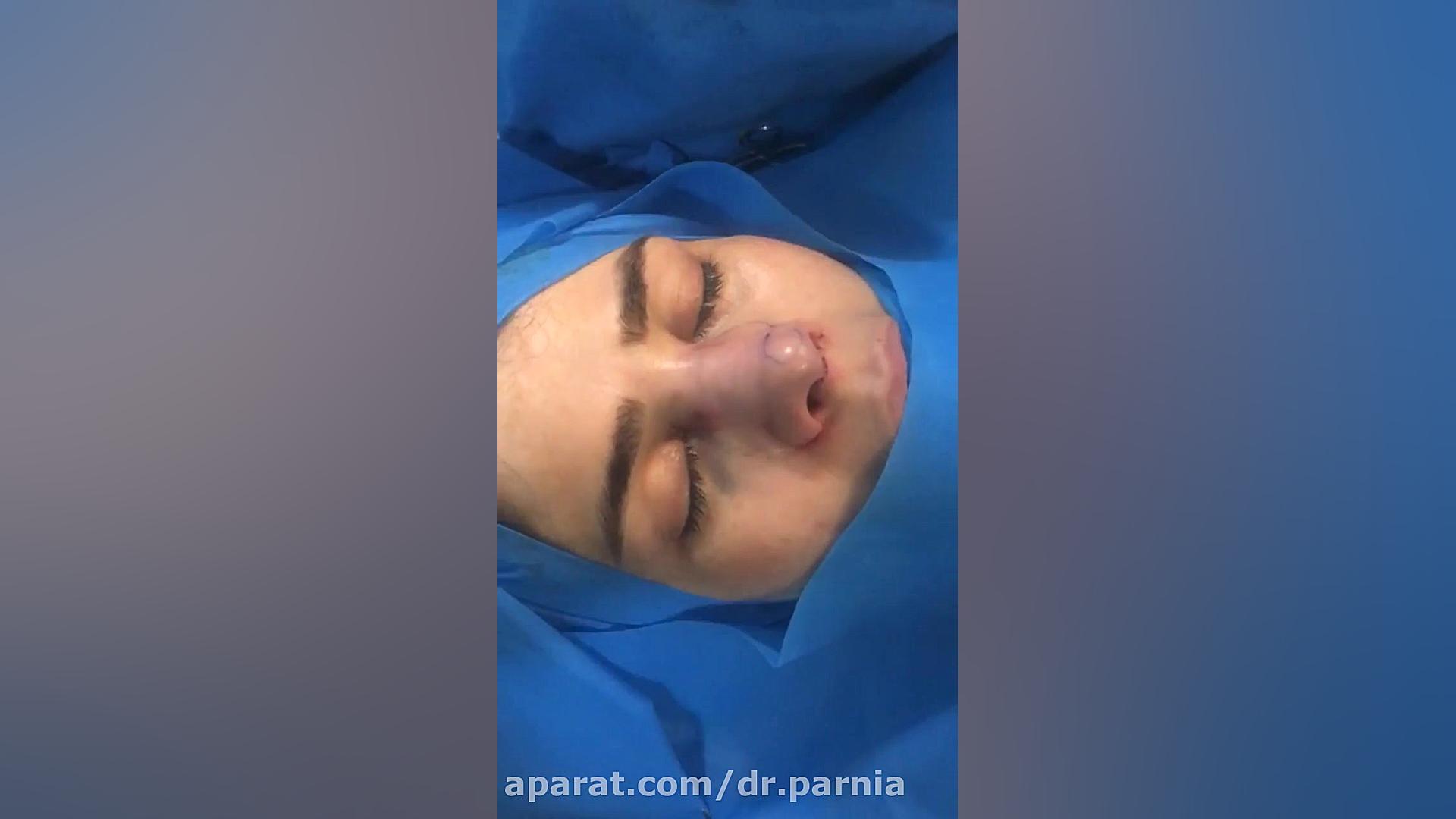 سپتورینوپلاستی دکتر رفیع پرنیا فوق تخصص پلاستیک