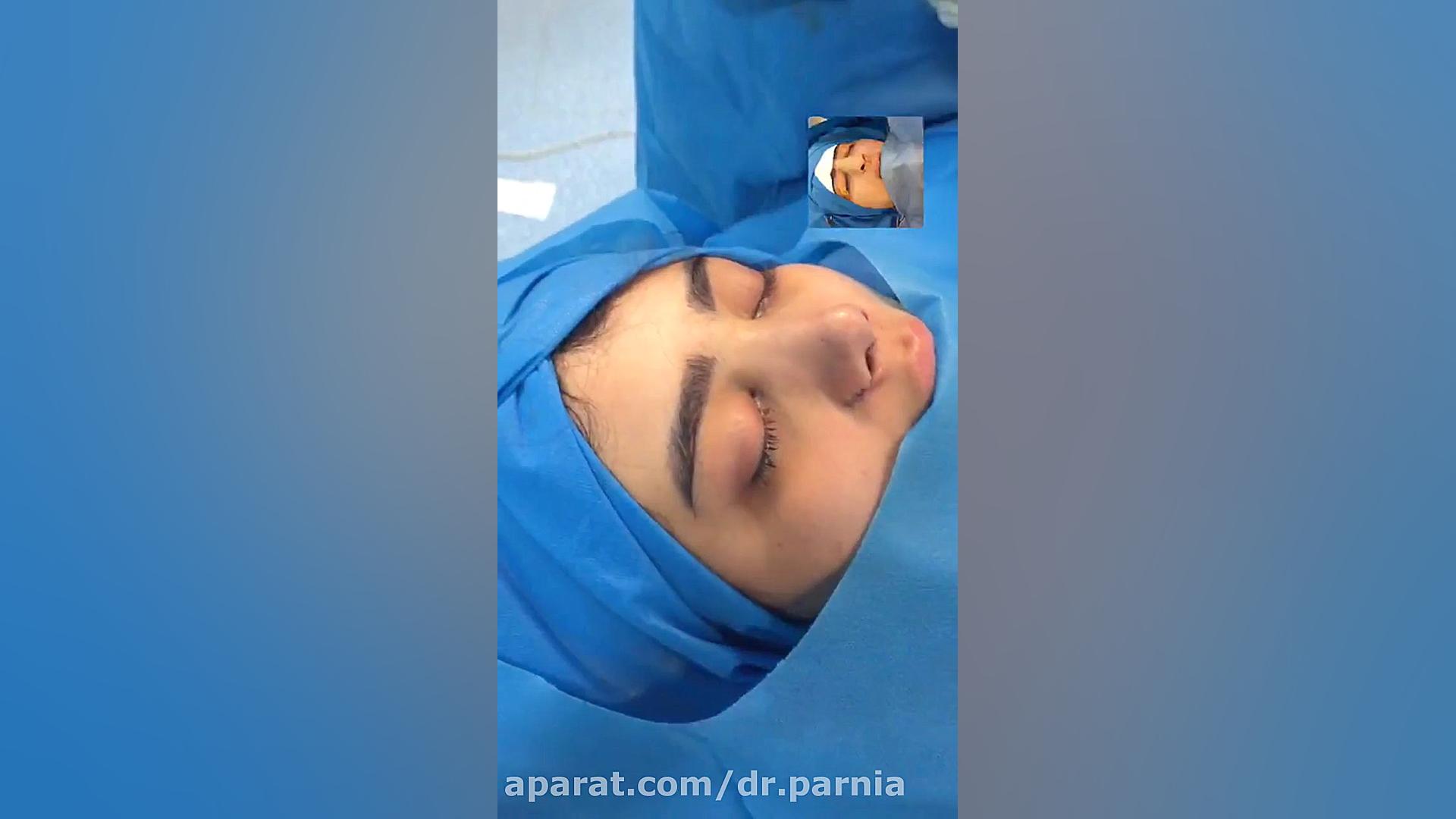 بلافاصله بعد از عمل بینی دکتر رفیع پرنیا فوق تخصص پلاستیک