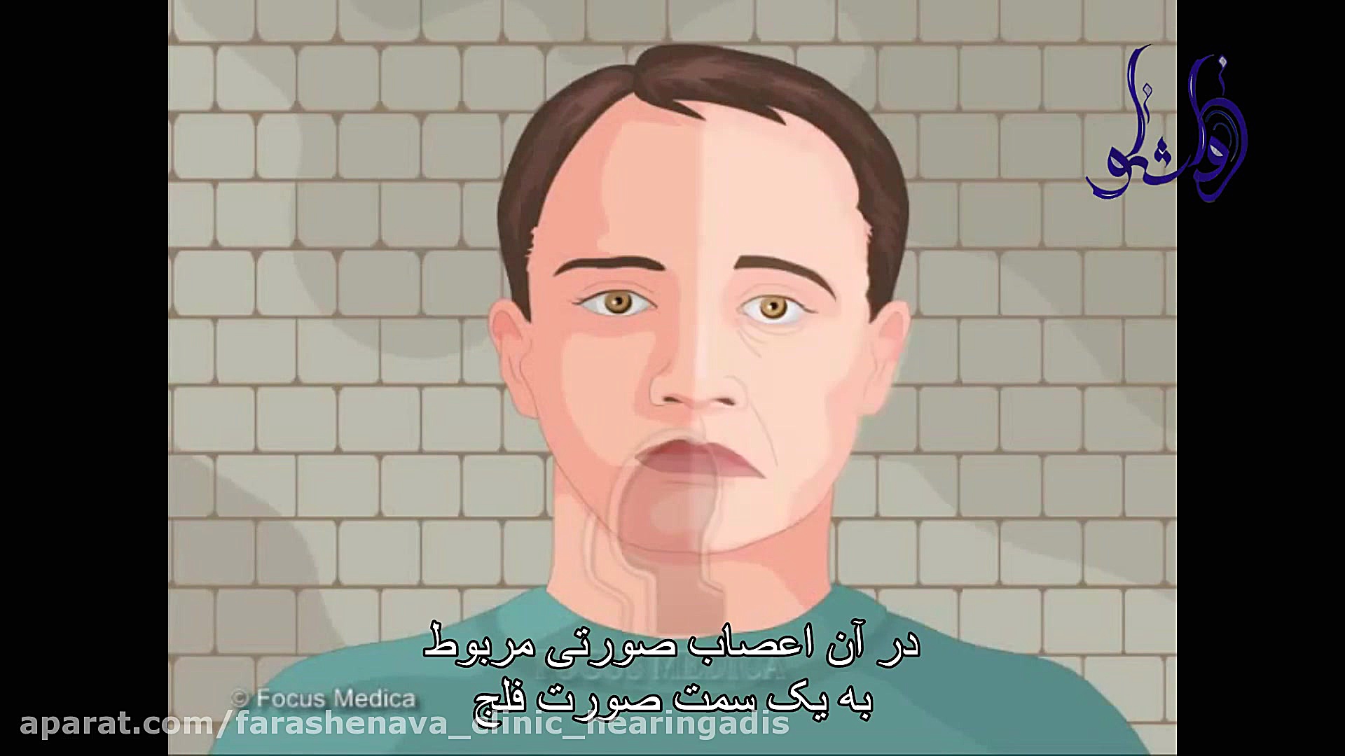 فلج عصب صورتی دندان شیری