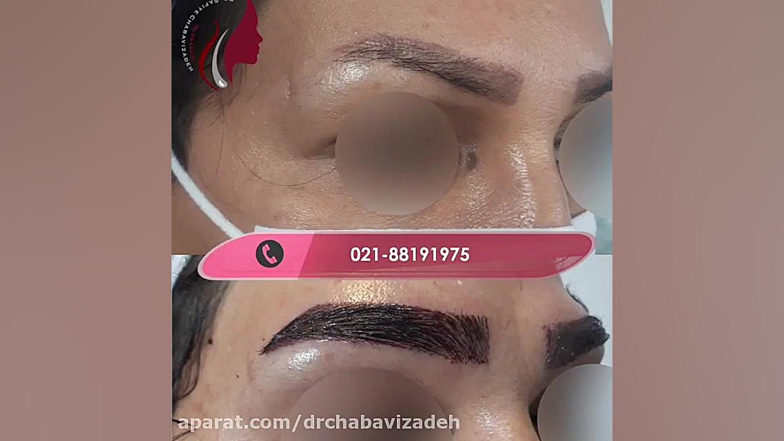 فیلم واقعی کاشت ابرو دکتر صفیه چعباوی زاده