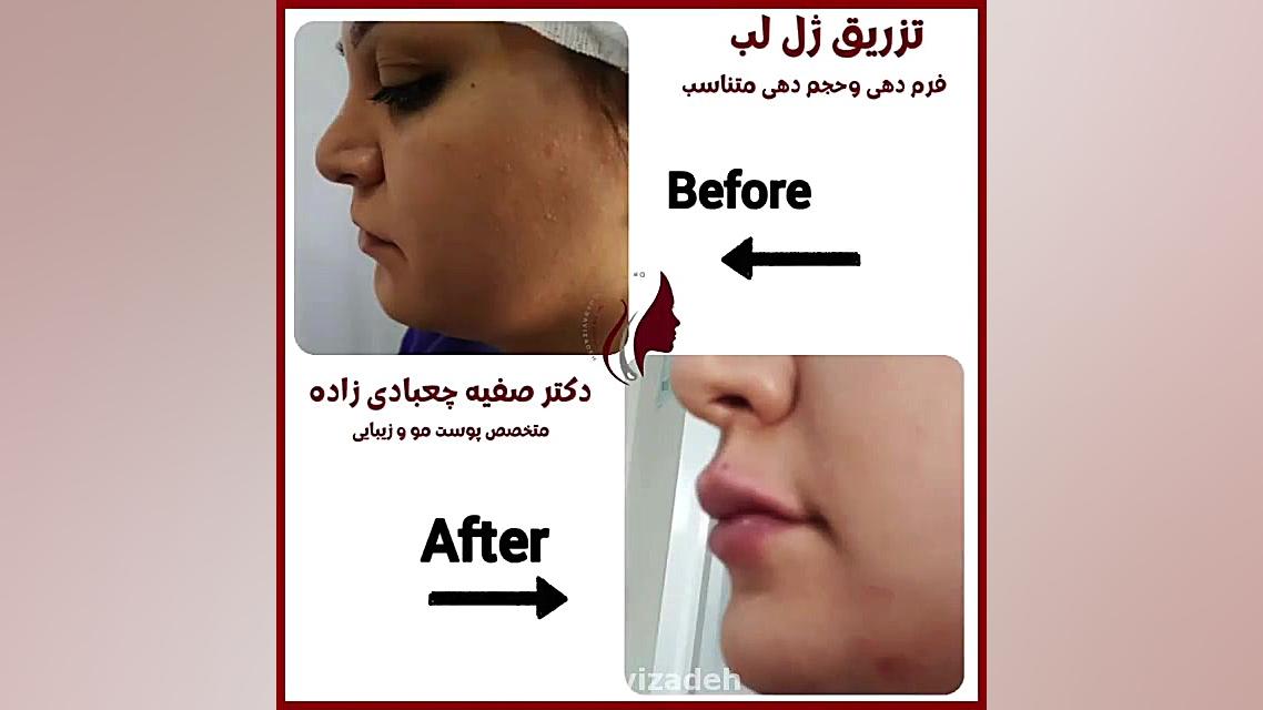 فیلم قبل و بعد تزریق ژل لب دکتر صفیه چعباوی زاده
