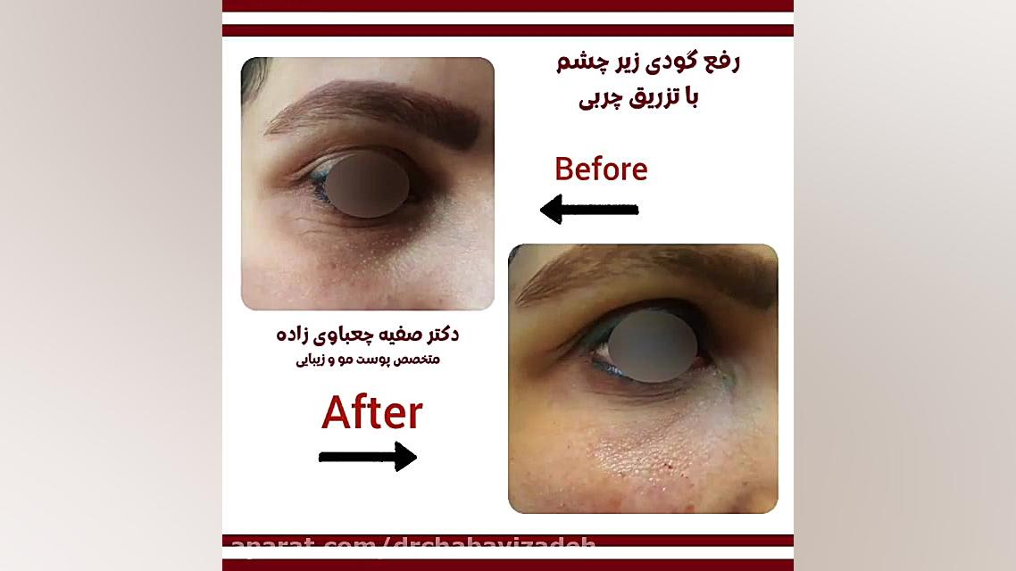 فیلم واقعی رفع گودی زیر چشم دکتر صفیه چعباوی زاده