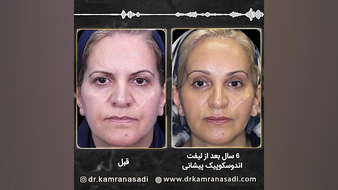 شش سال بعد از لیفت اندوسکوپی پیشانی هایپوپاراتیروئیدیسم
