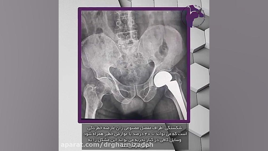شکستگی اطراف مفصل مصنوعی ران عارضه ای خطرناکی آنجلینا جولی