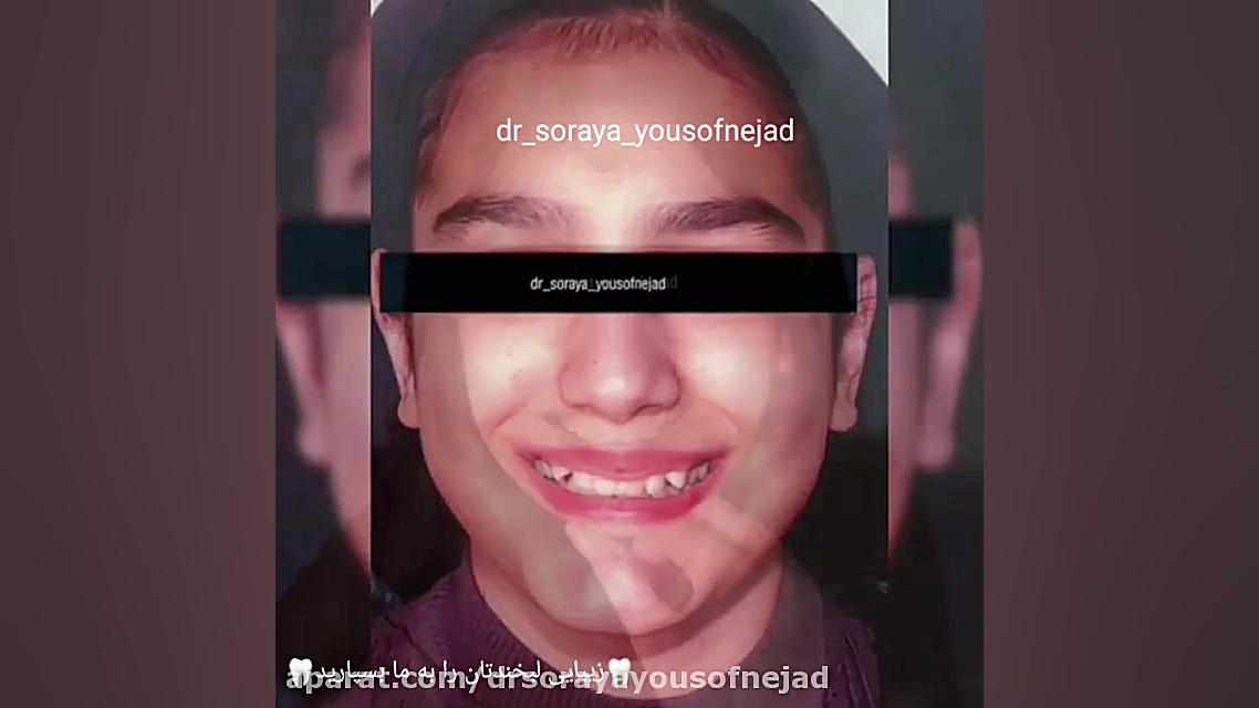 درمان ارتودنسی ثابت دکتر ثریا یوسف نژاد متخصص ارتودنسی بابل