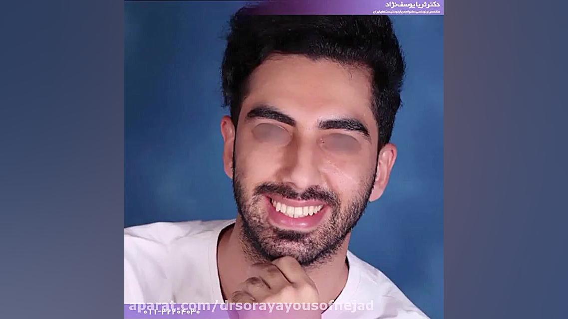 درمان ارتودنسی ثابت دو فک در کیس با بینظمی شدید دکتر ثریا یوسف نژاد متخصص ارتودنسی بابل