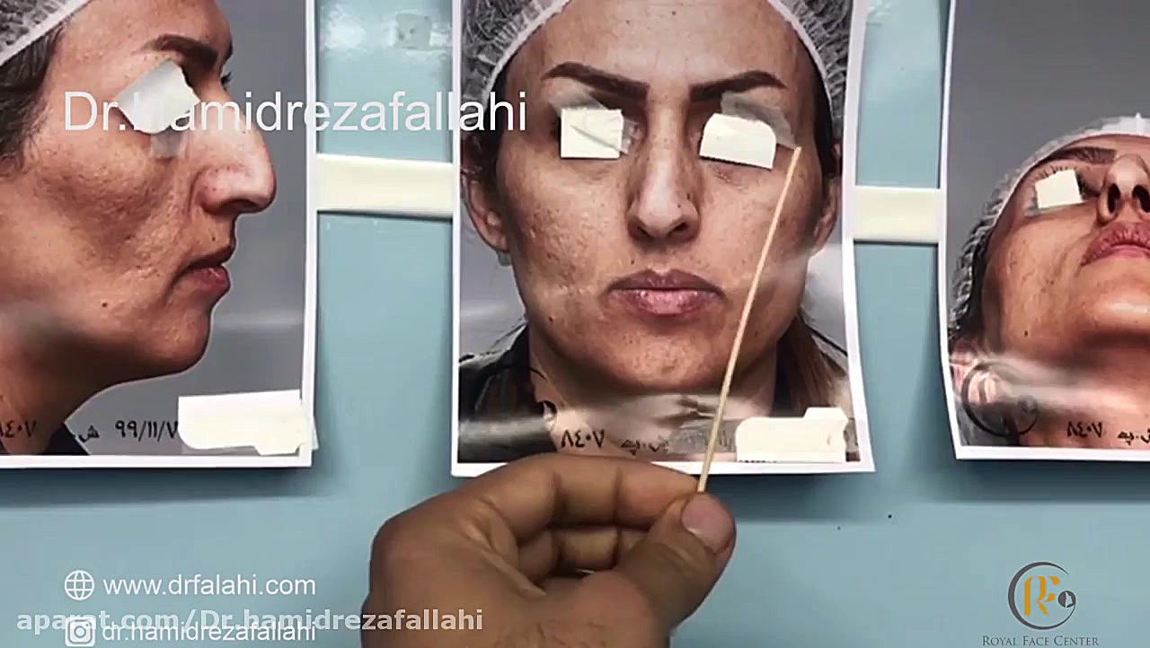 جراحی بینی پیش و پس از جراحی دکتر حمیدرضا فلاحی