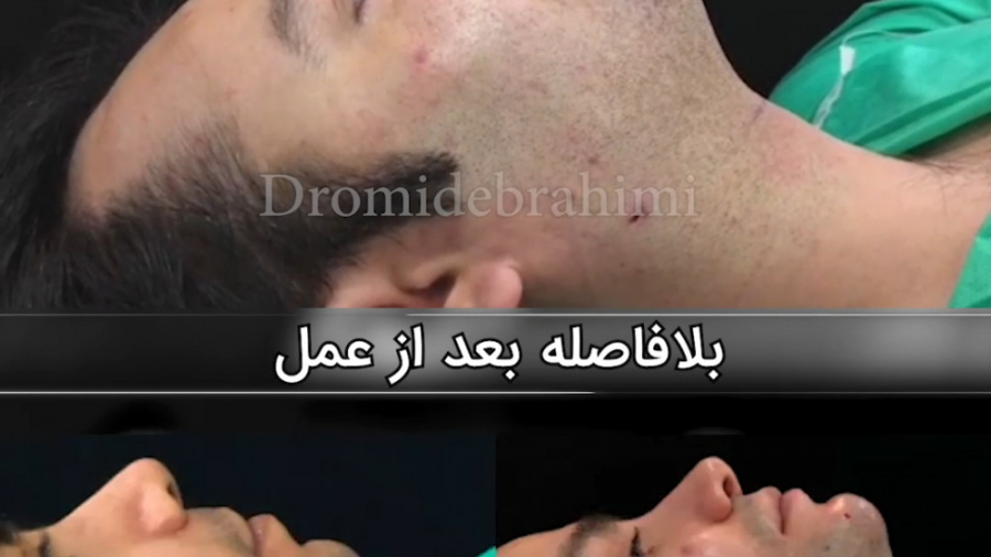 پروتز چانه و ساکشن غبغب توسط دکتر امید ابراهیمی دکتر امید ابراهیمی