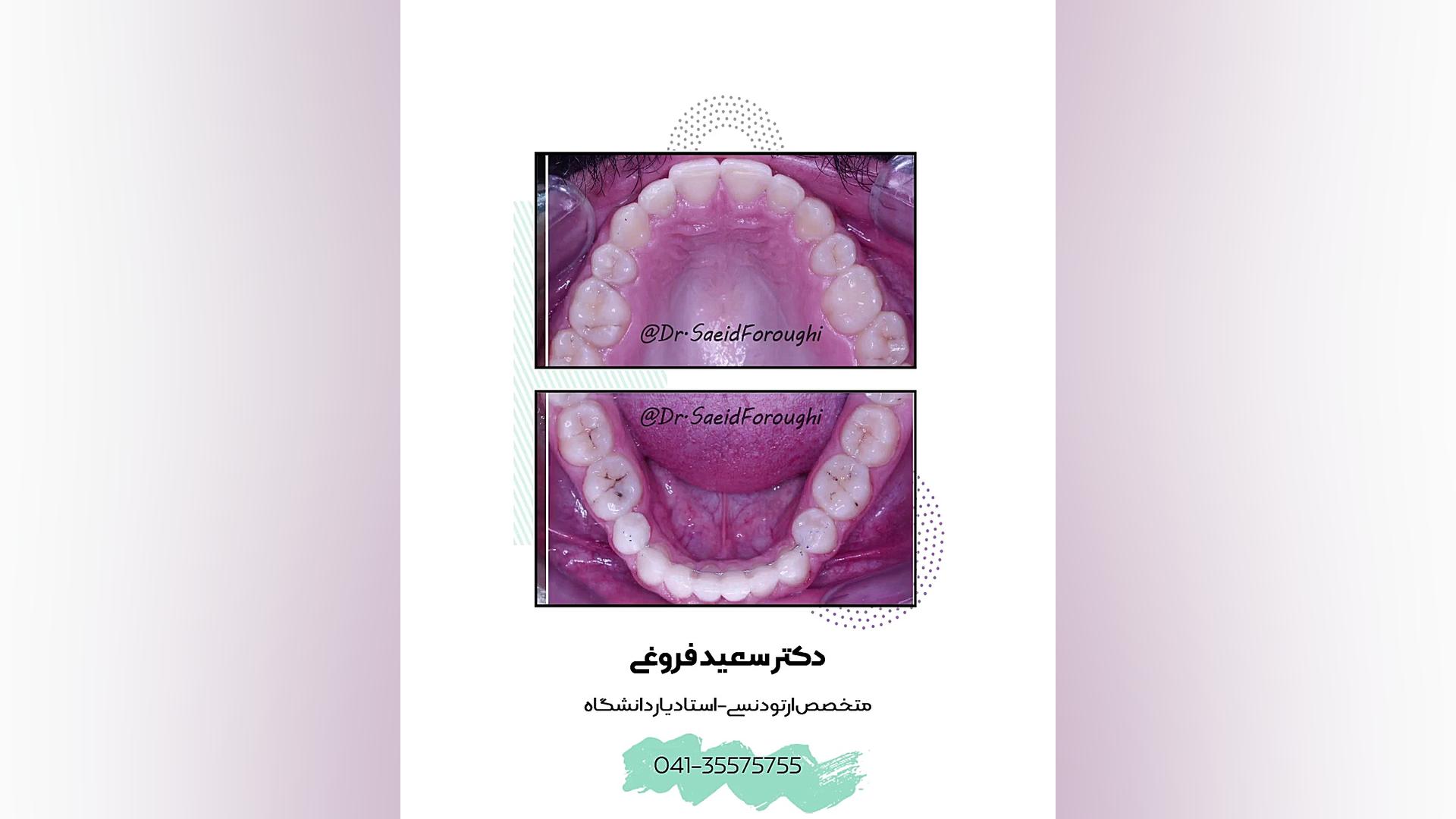درمان کمبود فضای شدید دندانها و اصلاح خطوط وسط دندانی و ایجاد قوسهای متقارن دندا دکتر سعید فروغی متخصص ارتودنسی