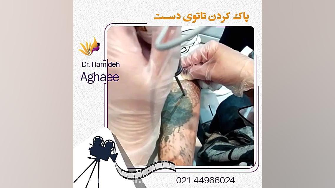 پاک کردن تتو دکتر حمیده آقایی